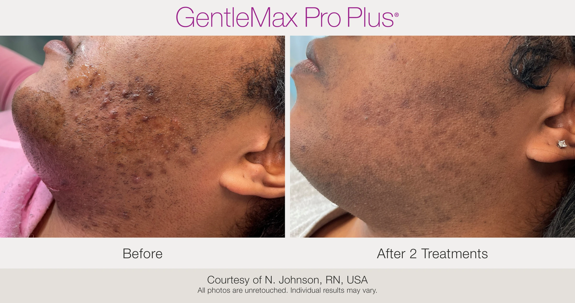 Cheek and jaw: before and after 2 treatments. GentleMax Pro Plus. Courtesy of N. Johnson, RN, USA.