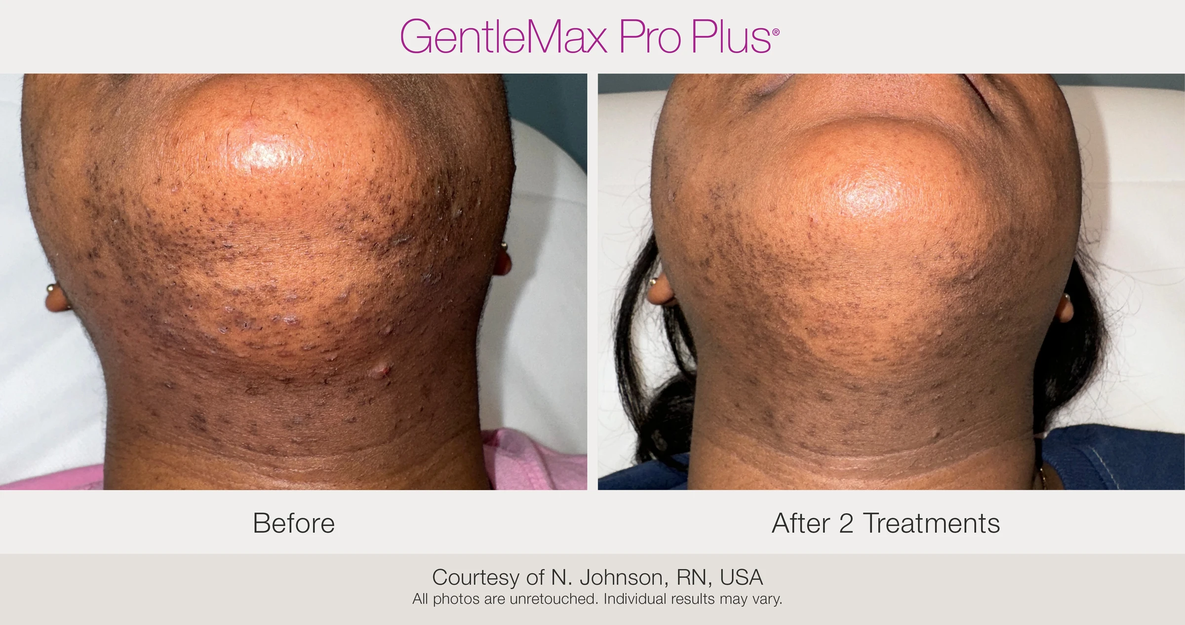 Chin: before and after 2 treatments. GentleMax Pro Plus. Courtesy of N. Johnson, RN, USA.