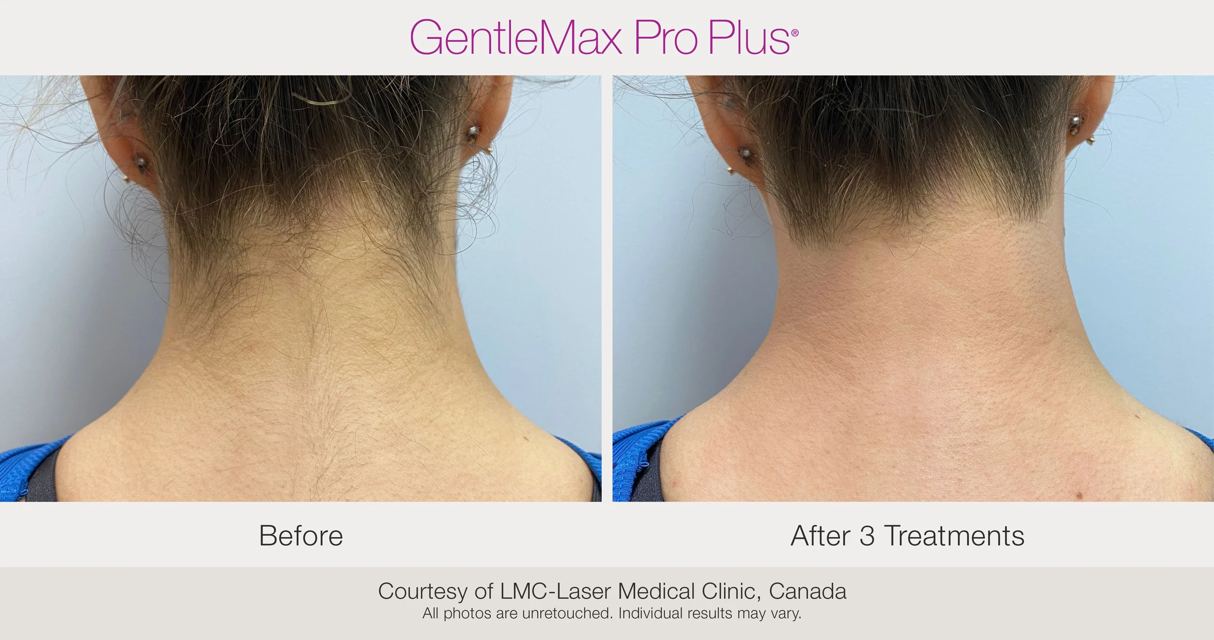Back of neck: before and after 3 treatments. GentleMax Pro Plus. Courtesy of LMC-Laser Medical Clinic, Canada.