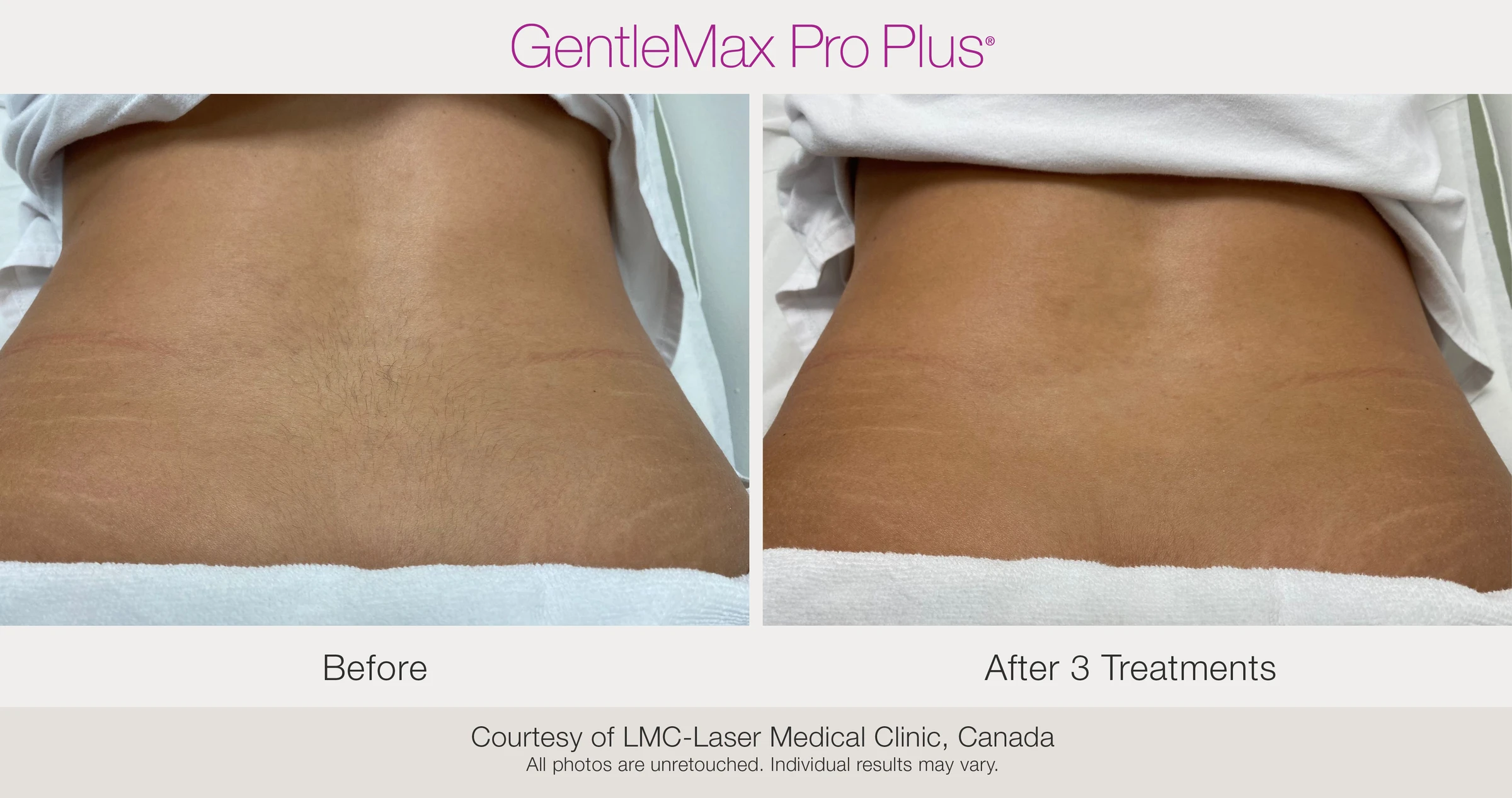 Abdomen: before and after 3 treatments. GentleMax Pro Plus. Courtesy of LMC-Laser Medical Clinic, Canada.