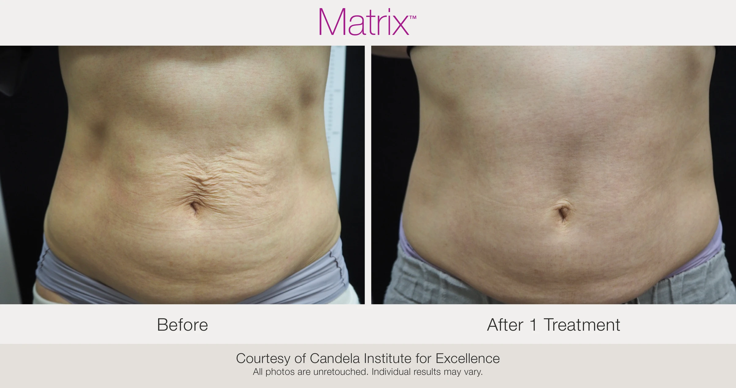 Before and after 1 RF microneedling treatment. Courtesy of Candela Institute for Excellence.