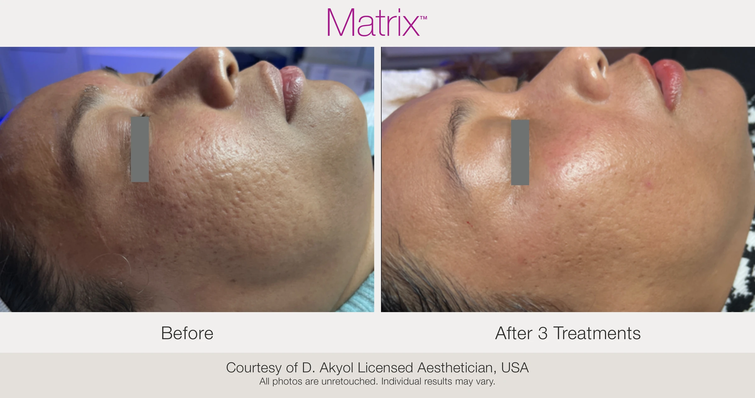 Before and after 3 RF microneedling treatments. Courtesy of D. Akyol, Licensed Aesthetician, USA.