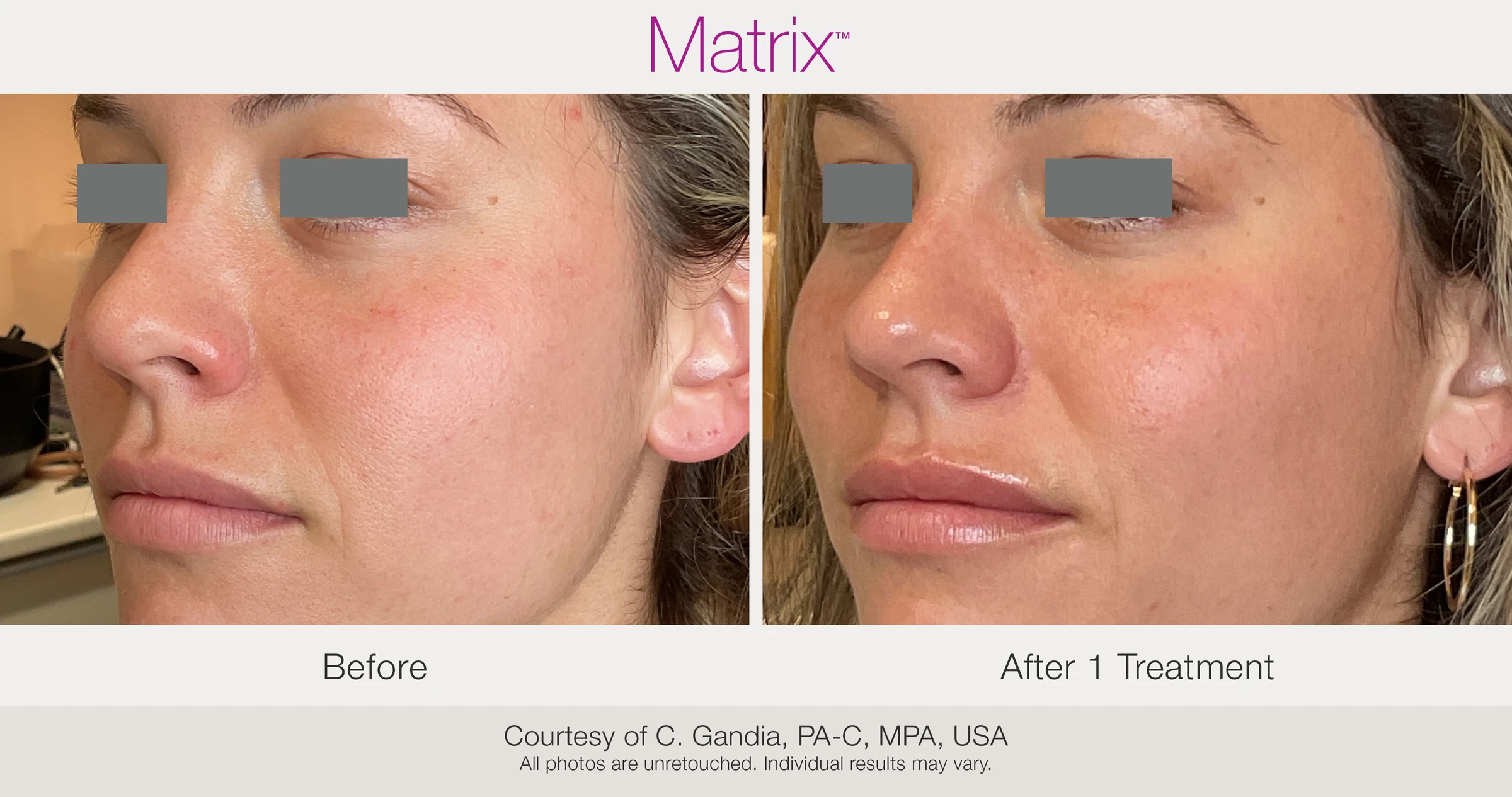 Before and after 1 RF microneedling treatment. Courtesy of C. Gandia, PA-C, MPA, USA.