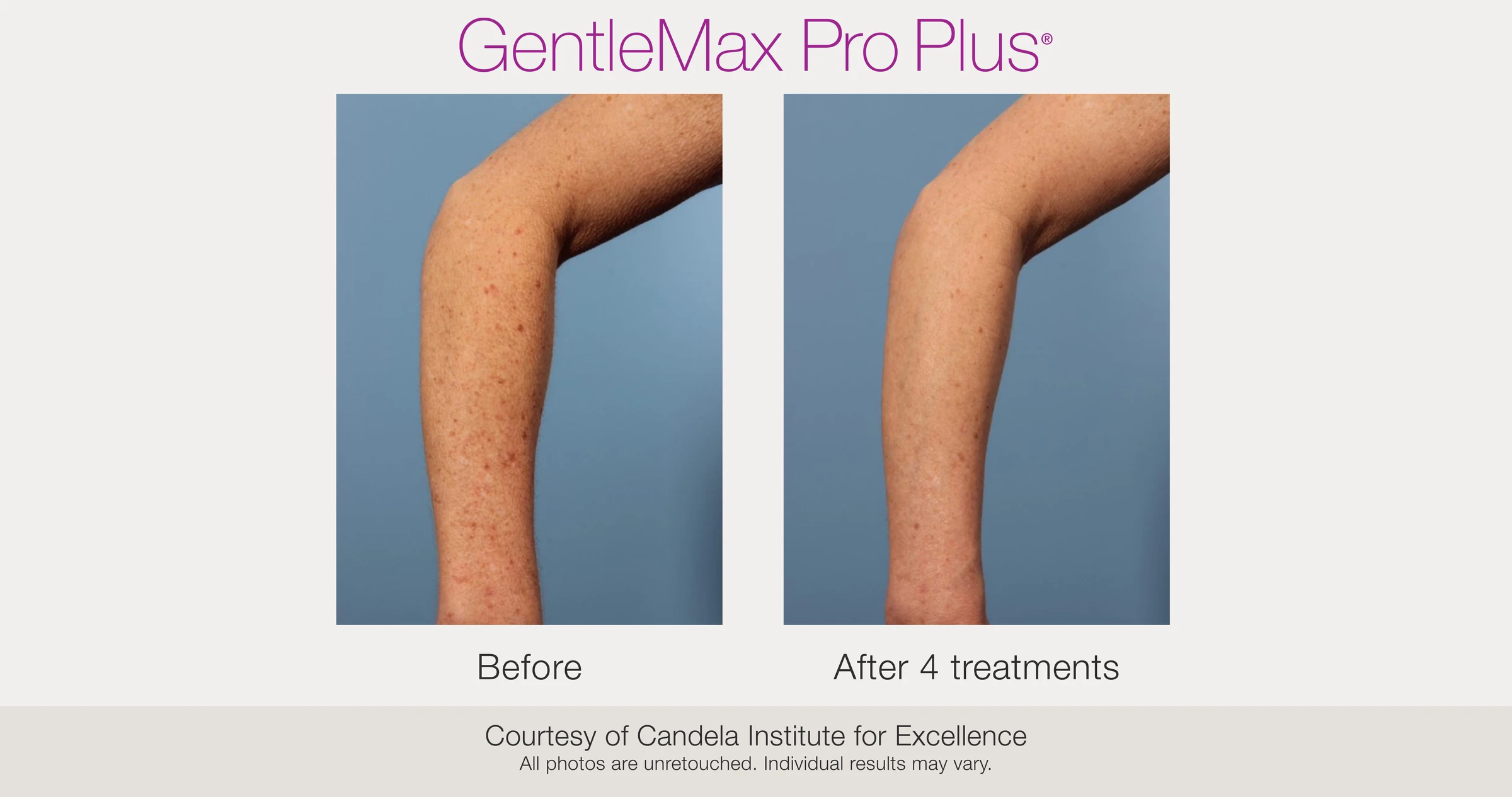 Arm: before and after 4 treatments. GentleMax Pro Plus. Courtesy of Candela Institute for Excellence.