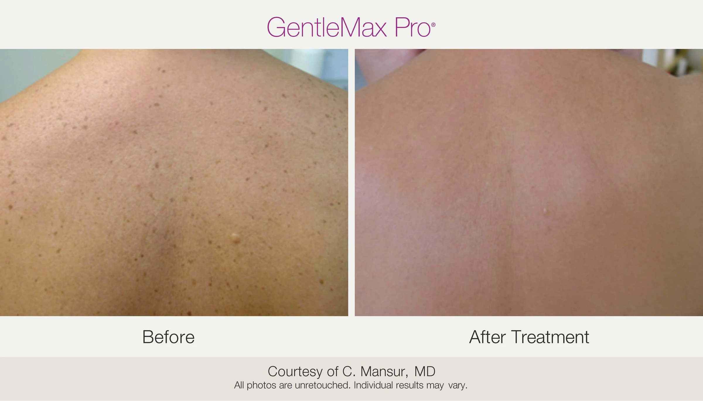 Back: before and after treatment. GentleMax Pro. Courtesy of C. Mansur, MD.