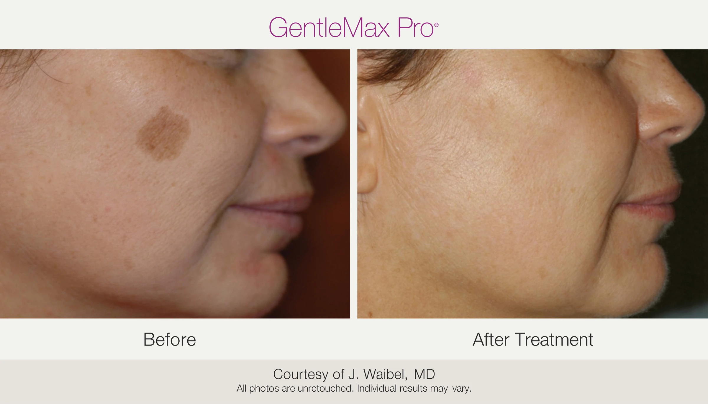 Cheek: before and after treatment. GentleMax Pro. Courtesy of J. Waibel, MD.