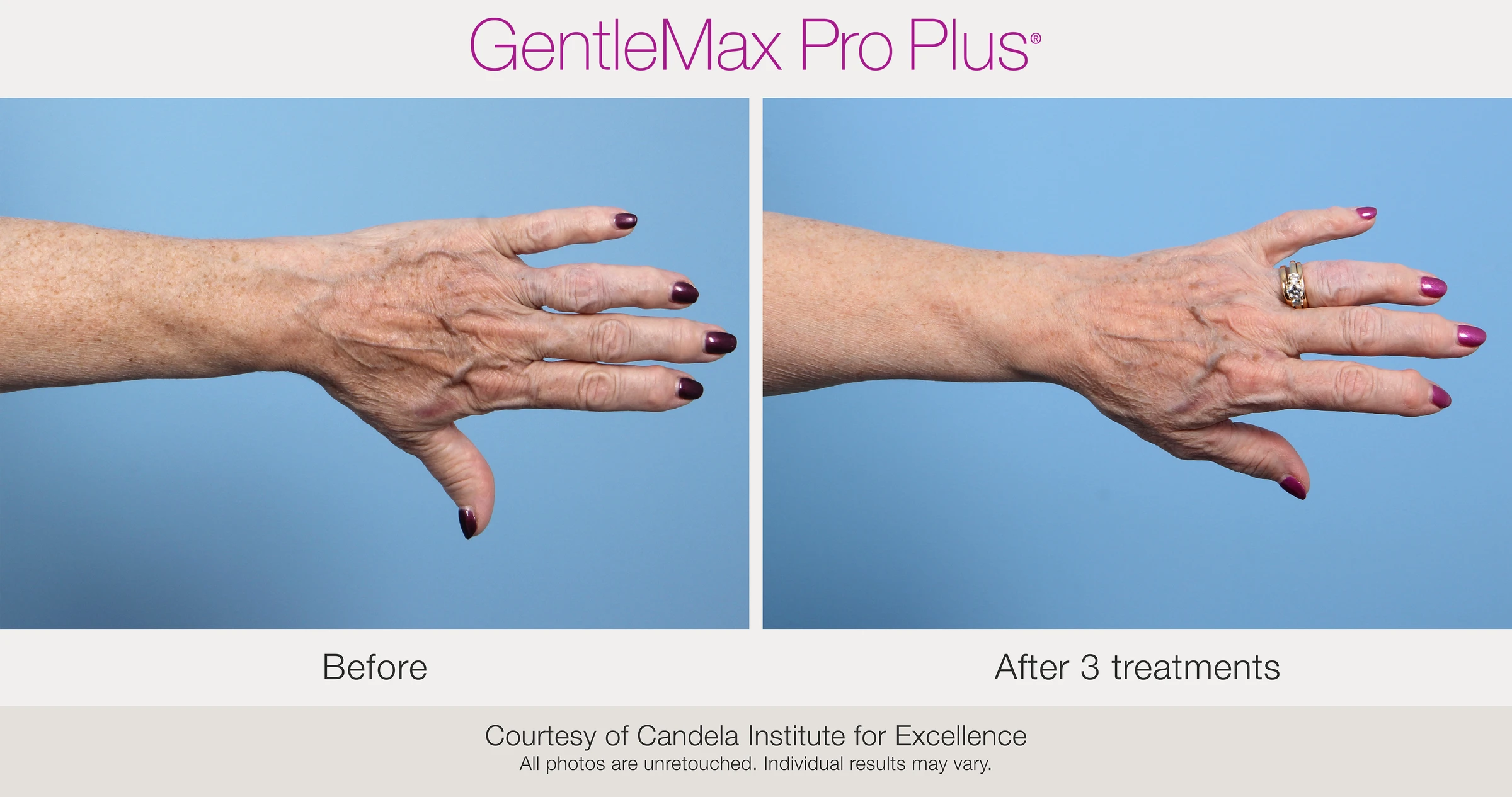 Hand: before and after 3 treatments, as labeled in the supplied image. GentleMax Pro Plus. Courtesy of Candela Institute for Excellence.