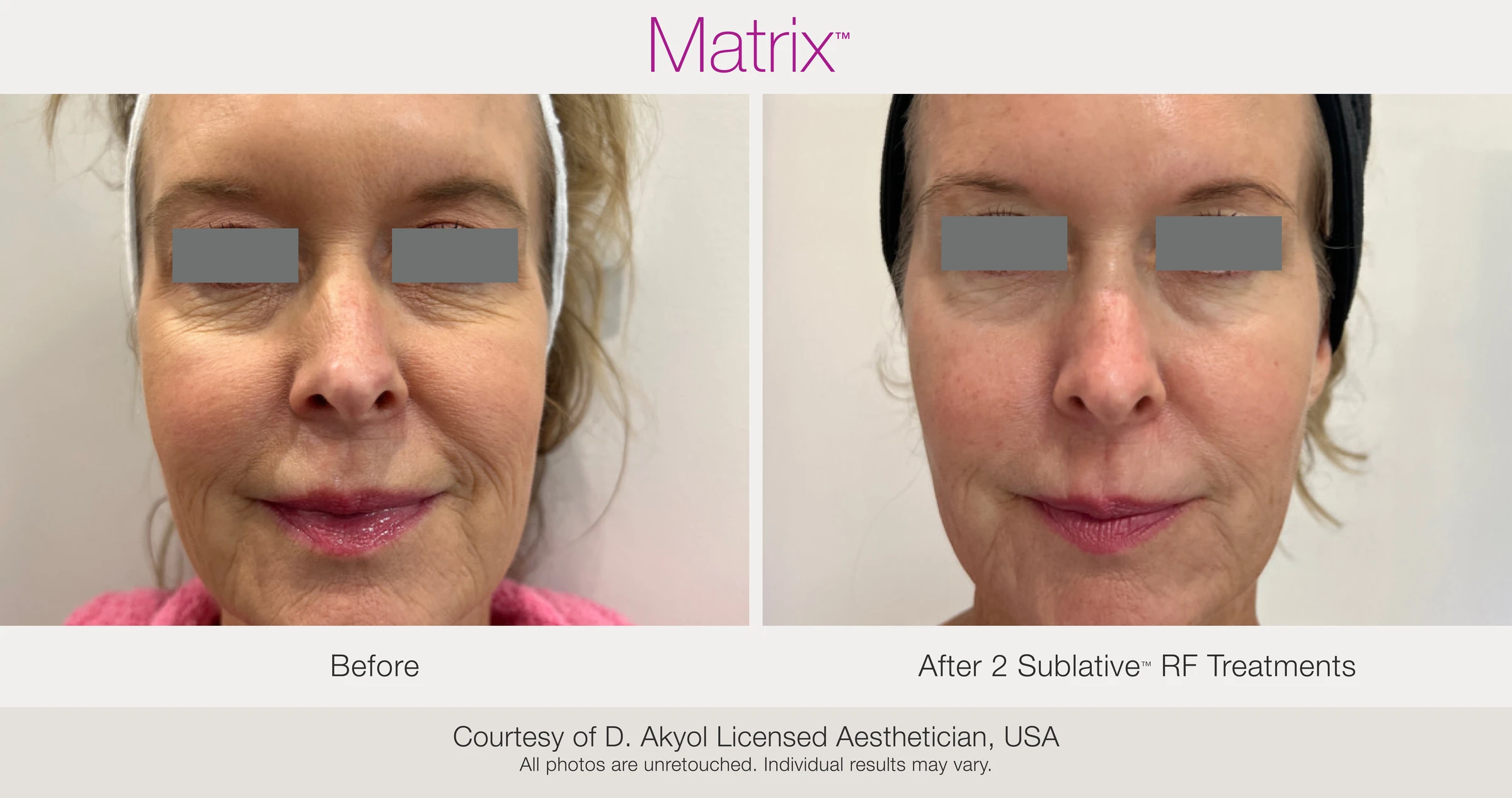 Before and after 2 Sublative RF treatments. Courtesy of D. Akyol, Licensed Aesthetician, USA.